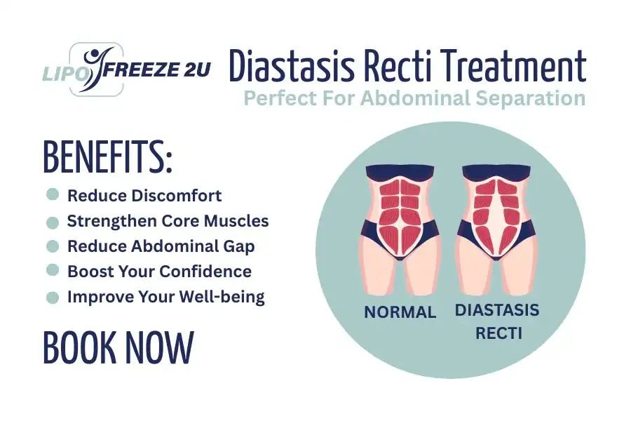 How Long Will It Take to See Improvements in Diastasis Recti Chelsea