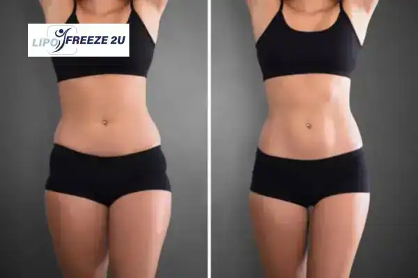 How Can LIPO FREEZE 2U Support Your Post-Pregnancy Body Recovery Chelsea?
