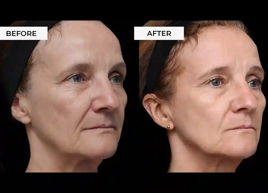 How Many RF Microneedling Sessions Will You Need to See a Difference Chelsea?