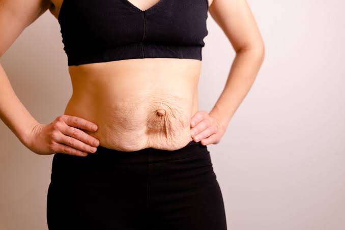 Is Surgery Really the Only Way to Repair Diastasis Recti Chelsea?