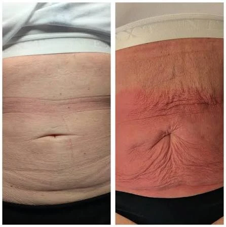 How Does RF Microneedling Improve Crepey, Thin and Uneven Skin Texture Chelsea?