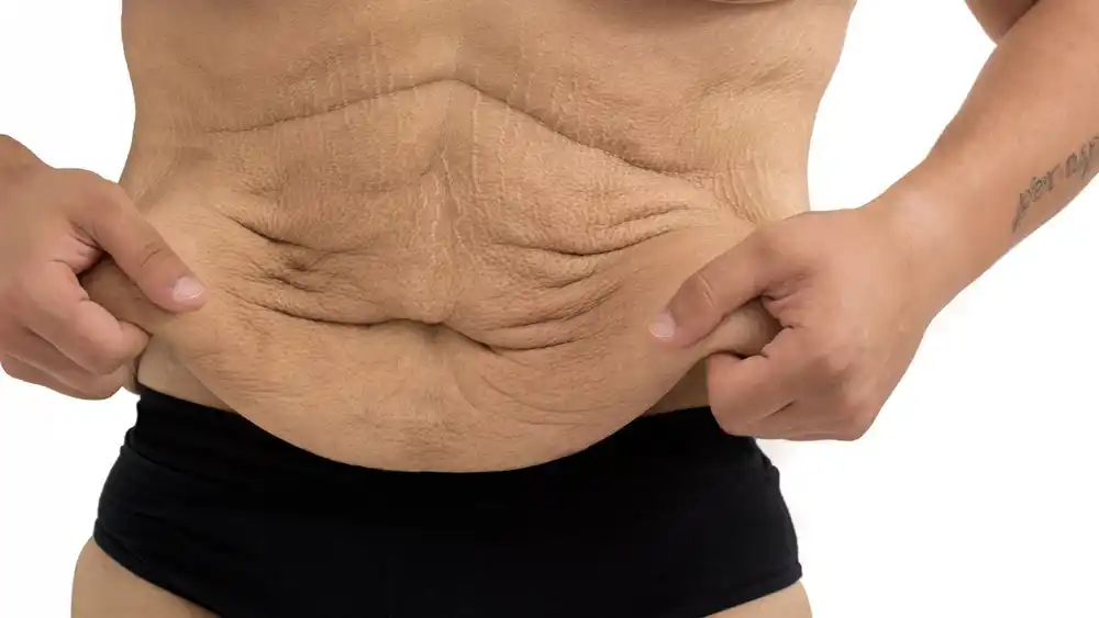 RF Microneedling for Loose Skin: How Can It Help Tighten and Reshape the Skin Chelsea?